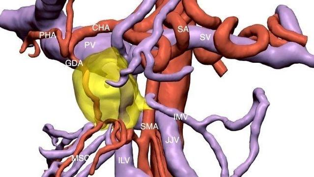 Model que reconstrueix el tumor, de color groc, en tres dimensions (Cella Medical Solutions)