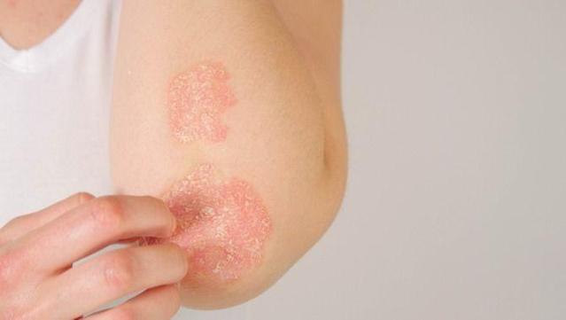 La psoriasi clàssica es manifesta amb plaques que es descamen als colzes, als genolls i a l'esquena. (iStock)