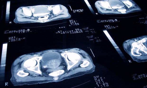 Imagen de unos escáneres de cáncer de próstata (Getty Images)