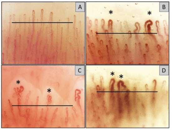 Four photos of capillaries in patients' fingernails.  Photo A shows lots of thin capillaries.  B shows lots of capillaries, but some -- marked with asterisks -- are thicker (dilated) enough that you can see the loops where the capillaries double back on themselves.  C and D show a lot of dilations but also a much lower density of capillaries.