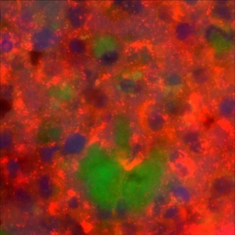 Flourescence microscopy with green blobs (I suppose P. aeruginosa biofilm) with small red rods (P. aeruginos) in a sea of granular red (I have reasons to believe that these are neutrophilic granulocytes with phagocytosed P.a.?)
