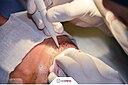A hair transplantation surgery
