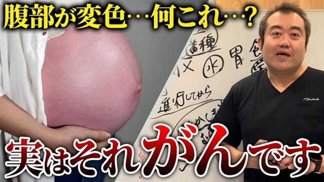 放置すると超危険！あまり知られていない卵巣がんと腹水の関係を産婦人科医が解説！