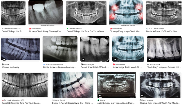 Multiple dental x-rays from Google Image search