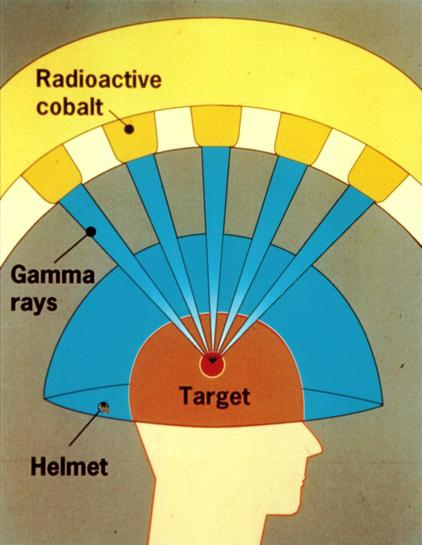 a diagram from wikipedia article illustrating the “gamma knife” being used on a brain