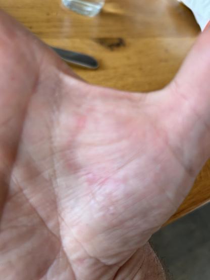 Gebrandmerkte hand. Nounou, niet overdrijven Sjaak.

Afdruk van bbq-rooster op hand