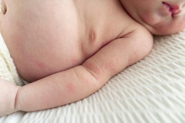 Newborn baby body with red rash