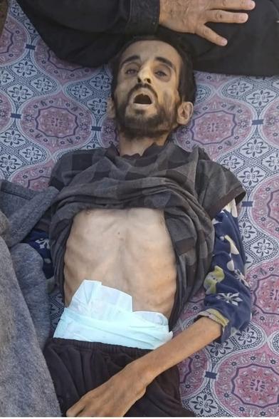 A severely emaciated Palestinian man lies lifeless on a patterned mat. His ribs and bones are sharply visible due to extreme starvation. His mouth is open, his face gaunt, and his eyes partially shut. He wears a thin shirt pulled up, pajama pants, and an adult diaper. A hand rests gently near his head, possibly a loved one mourning him. The image reflects the tragic consequences of starvation in Gaza.
