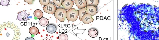 Schematics of components of the tumor microenvironment in pancreatic cancer, with aspects of TLS formation