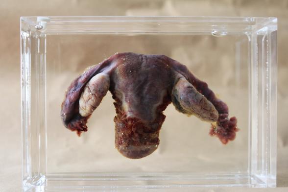 Photo of a preserved human uterus, uterine tubes, and ovaries preserved in a perspex box. The organ is an elongated oblong, with whitish ovaries and tubes hanging over it.