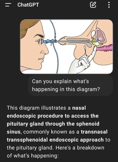 Can you explain what's happening in this diagram?
This diagram illustrates a nasal endoscopic procedure to access the pituitary gland through the sphenoid sinus, commonly known as a transnasal transsphenoidal endoscopic approach to the pituitary gland. Here's a breakdown of what's happening:

the diagram is of a cystoscopy and pr examination.