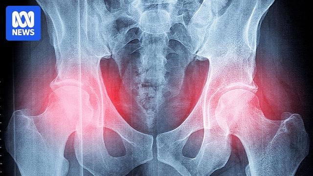 Study backing OsteoStrong 'bone-strengthening' exercise program should be retracted: experts