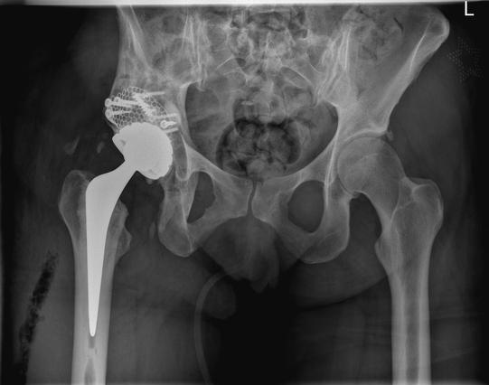 A grayscale X-ray image displaying a human pelvis and hips. The left hip features a clearly defined hip replacement implant, composed of a radiopaque metal prosthetic stem fitted into the femur and a metal socket attached to the pelvic bone. These components are brighter and more opaque compared to the surrounding skeletal structures, signifying their artificial material. The right hip appears intact and natural without any prosthetic parts. The bones are well-aligned, and the joint spaces are visible. An “L” marker in the top right corner of the image indicates the orientation, confirming the left side of the body. The X-ray provides a clinical, high-resolution view valuable for evaluating the condition and placement of the implant as well as the surrounding anatomy.