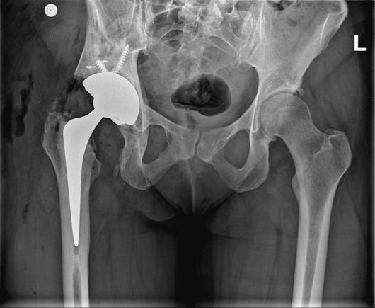 A high-contrast black-and-white X-ray image of a human pelvis. The image prominently displays a left hip replacement, indicated by the presence of a radiopaque artificial implant. The prosthetic structure includes a long metal stem embedded within the femur, a rounded metal head that mimics the natural femoral head, and a corresponding metal socket integrated into the acetabulum of the pelvis. The clear distinction of the "L" marker confirms the implant's placement on the left side. The right hip joint appears intact and natural, without any signs of prosthesis. Bony details such as the sacrum, iliac crests, and proximal femurs are visible, providing context for orthopedic evaluation. This diagnostic image would typically be used to assess post-operative alignment and the stability of the implanted components.