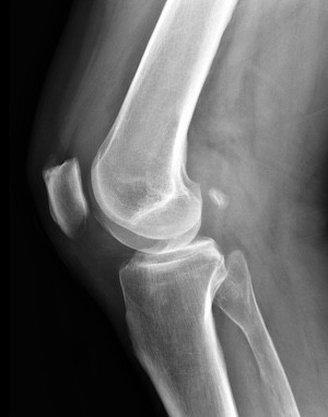knee x-ray
