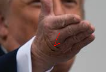 Trump wound care top of hand