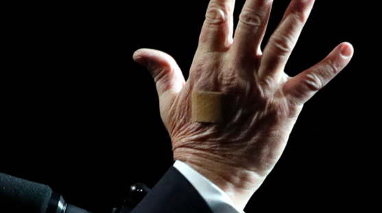 Trump wound care top of hand
