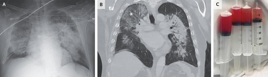 X-ray, CT and BAL from a patient with pulmonary hemorrhage from ANCA vasculitis