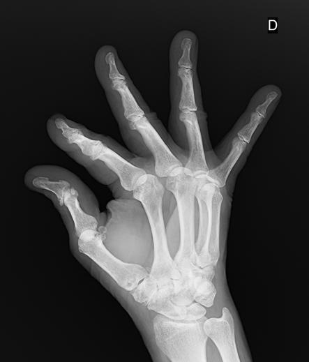 an xray of my right hand