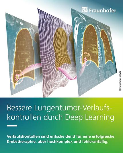 Die Deep-Learning-Software SPIRABENE kann CT-Aufnahmen in Rekordzeit bewerten und vergleichen und spart so Kosten und verbessert die Heilungschancen.
