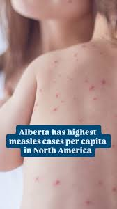 Alberta has highest
measles cases per capita
in North America