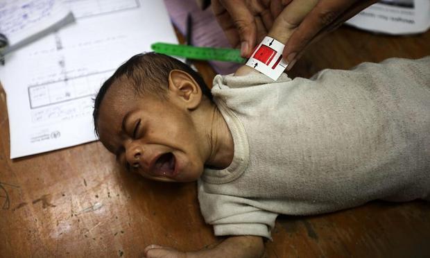 Una niña palestina con desnutrición en Patient Friends Association Hospital en Gaza el 22 de julio de 2025. (Majdi Fathi / Getty Images)
