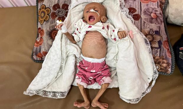 Zainab Abu Haleeb, una niña palestina de cinco meses con desnutrición, yace en una cama en el hospital Nasser en Khan Younis (Gaza), el 15 de julio de 2025. (Hussam Al-Masri / Reuters)