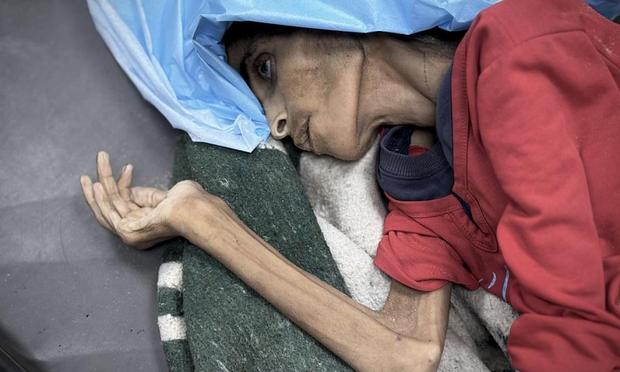 El cuerpo de Rahil Mohammed Rasras, 32 años, yace en una camilla del hospital Nasser, en Gaza, tras morir por desnutrición severa el 21 de julio de 2025. Pesaba 25 kilos. (Abdallah F.s. Alattar / Anadolu via Getty Images)