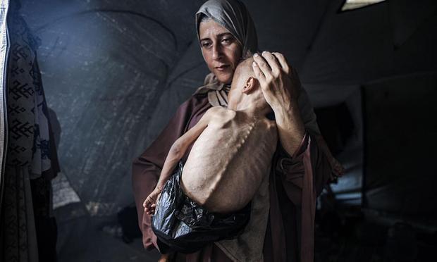 Muhammad Zakariya Ayyoub al-Matouq, un niño de un año y medio en la Ciudad de Gaza, pesa seis kilos por la desnutrición forzada por Israel. (Ahmed Jihad Ibrahim Al-arini / Anadolu via Getty Images)
