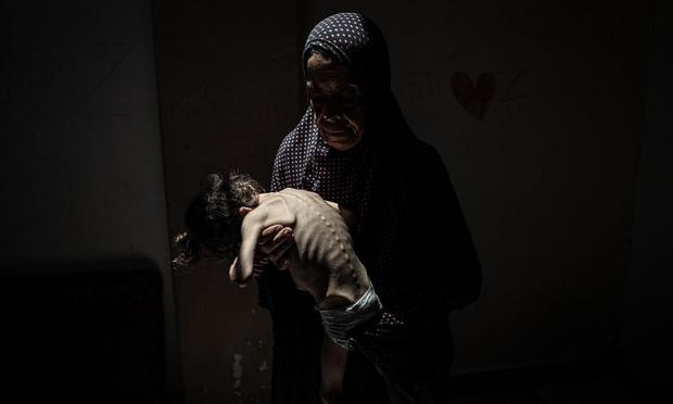 Misk al-Madhoun, de seis años, que padece atrofia cerebral y pesa sólo cuatro kilos, en brazos de su madre, el 31 de julio de 2025, en la ciudad de Gaza. (Khames Alrefi / Anadolu via Getty Images)