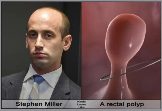 Stephen Miller & a rectal polyp