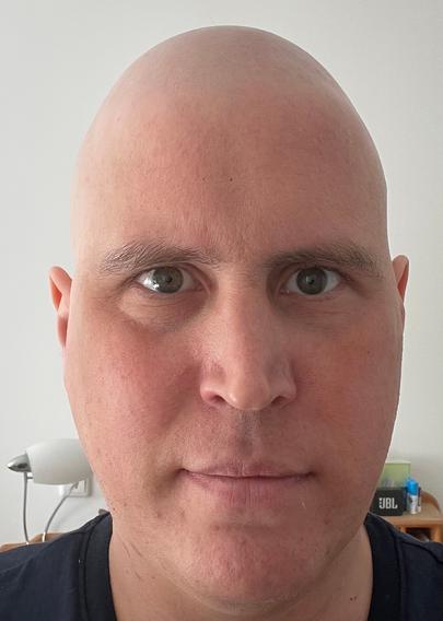 Ich mit Glatze