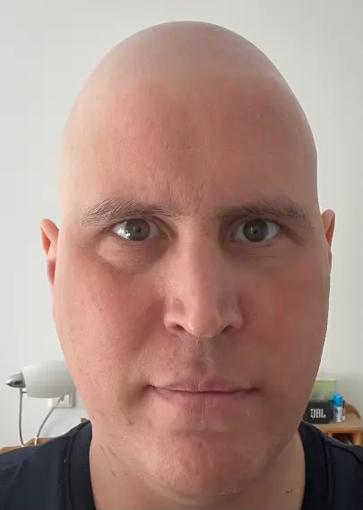 Ich mit Glatze