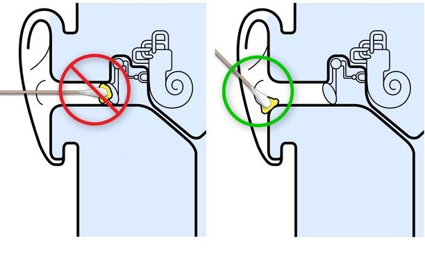A diagram of the ear. Pushing a Q-Tip into the inner ear risks compaction of wax against the eardrum. Instead, remove any wax at or near the opening.