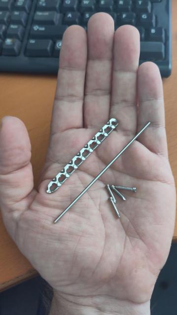 De metalen stukken die eruit zijn gehaald op mijn hand: een lange pen die in lengterichting door het bot zat, de plaat die erop geschroefd zat en 4 schroeven.
