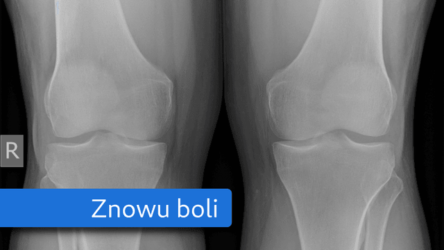 Na zdjęcie rentgenowskie kolan nałożony niebieski pasek z białym napisem „Znowu boli”