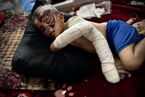 Ahmed Abu Sahloul, de cuatro años, lucha por su vida en el hospital Nasser de Khan Yunis, (Gaza), el 13 de agosto de 2025, tras ser hedido en un ataque de Israel. (Doaa Albaz / Anadolu via Getty Images))