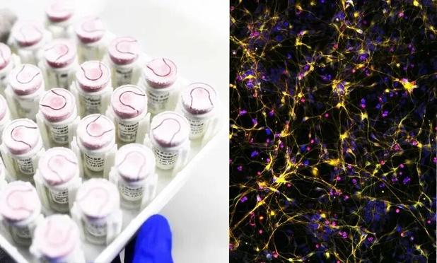 <p>人工多能性幹細胞（iPS細胞、iPSC）由来のパーキンソン病治療薬を開発するスタートアップ企業「睿健医薬（iRegene Therapeutics）」がこのほど追加のシリーズBラウンドで、北極光創投（NLVC）などから資金を調達した。これにより、シリーズBでの計調達額は3億元（約60億円）を超えた。資金は、パーキンソン病治療薬「NouvNeu001」「NouvNeu003」や眼科用剤「NouvSight001」の臨床開発、生産能力の拡大などに用いられる。</p>
<p>2017年に設立された睿健医薬は、iPS細胞に転写因子を導入して分化誘導した医薬品の開発を手がけている。主力製品のNouvNeu001はヒトiPS細胞由来ドーパミン神経前駆細胞で、多施設共同研究の第II相臨床試験を開始した。</p>
<p>創業者の魏君CEOによると、NouvNeu001の第I相臨床試験では、細胞移植から15カ月後の患者で優れた安全性と忍容性が認められた。PET検査でも、免疫抑制剤を使わない状態で、細胞が患者の体内に長期間定着していることが確認された。</p>
<p>NouvNeu001は2025年8月半ばに、米国食品医薬品局（FDA）から優先審査にあたる「ファストトラック（Fast Track）」指定と適用拡大承認を取得。今後はFDAが臨床試験の手法や必要なデータなどについて、同社に対して個別指導を実施する見通しで、臨床応用や商用展開の加速が期待される。</p>
<p>このほか、若年性パーキンソン病患者向け細胞治療薬「NouvNeu003」も独自に開発している。すでに終了した第1相臨床試験では順調にエンドポイントをクリアし、製品の安全性と有効性が予備的に検証された。</p>
<p>投資家である北極光創投の宋高広パートナーは、睿健医薬について「先進的な分化誘導技術プラットフォームと専門チームを基盤に、再生医療分野で大きな進展を遂げている」と評価。特にパーキンソン病治療の開発パイプラインが順調に進展しており、これまでの試験でも極めて高い安全性と有効性が確認されたことから、「米国や日本と肩を並べて競い合える水準に達した」との見方を示した。</p>
<p>＊1元＝約21円で計算しています。</p>
<p>（翻訳・大谷晶洋）</p>