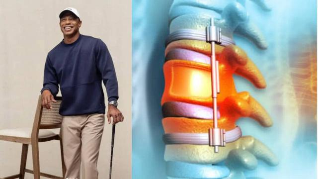 Tiger Woods Undergoes 7th Back Surgery After Collapsed Disc