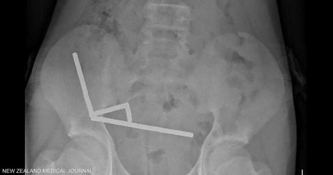 صبي يبتلع 100 مغناطيس اشتراها من "تيمو".. والشركة تعلق