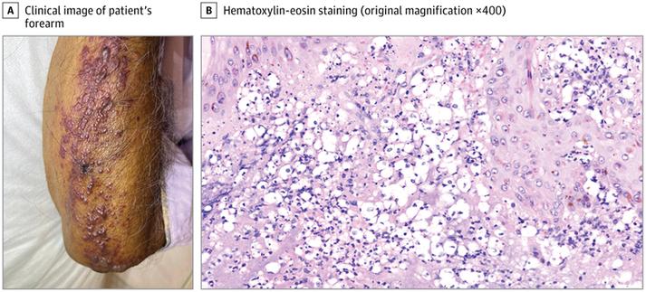 A. Edematous, violaceous plaques on the forearms are shown. 
B, High-power magnification shows a dense upper to mid-dermal neutrophilic infiltrate admixed with vacuolated spherical structures.