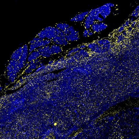 Tissue section, which appears mostly dark blue, on a black background. The blue tissue is interspersed with yellow dots. The image depicts a pancreatic tumor after combination treatment. This treatment causes the immune system's scavenger cells (macrophages; yellow) to stop promoting tumor growth and instead stimulate the immune system to fight it © Charité | Zuzana Tatarova