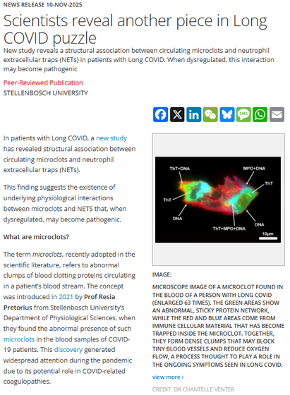 News Release 10-Nov-2025

Scientists reveal another piece in Long COVID puzzle

New study reveals a structural association between circulating microclots and neutrophil extracellular traps (NETs) in patients with Long COVID. When dysregulated, this interaction may become pathogenic

Peer-Reviewed Publication

Stellenbosch University

FacebookXLinkedInWeChatBlueskyMessageWhatsAppEmail
 

image:

Microscope image of a microclot found in the blood of a person with Long COVID (enlarged 63 times). The green areas show an abnormal, sticky protein network, while the red and blue areas come from immune cellular material that has become trapped inside the microclot. Together, they form dense clumps that may block tiny blood vessels and reduce oxygen flow, a process thought to play a role in the ongoing symptoms seen in Long COVID.

view more

Credit: Dr Chantelle Venter

In patients with Long COVID, a new study has revealed structural association between circulating microclots and neutrophil extracellular traps (NETs).

This finding suggests the existence of underlying physiological interactions between microclots and NETS that, when dysregulated, may become pathogenic.

What are microclots?