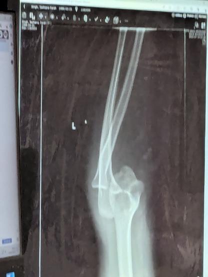 An x-ray of a dislocated elbow