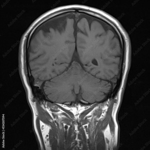 brain MRI