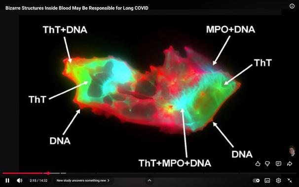 Description by Gemini Fast: A false-color, fluorescence micrograph of a microscopic structure, likely a Long COVID microclot. The structure glows red, green, and cyan against a black background and is labeled with arrows pointing to its components: ThT (Thioflavin T, indicating amyloid structures), MPO (Myeloperoxidase), and DNA, suggesting a complex of Neutrophil Extracellular Traps (NETs).