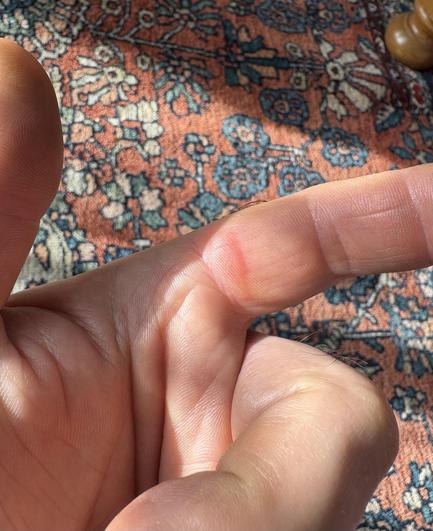 My index finger with a big, red, sore blister at the base.