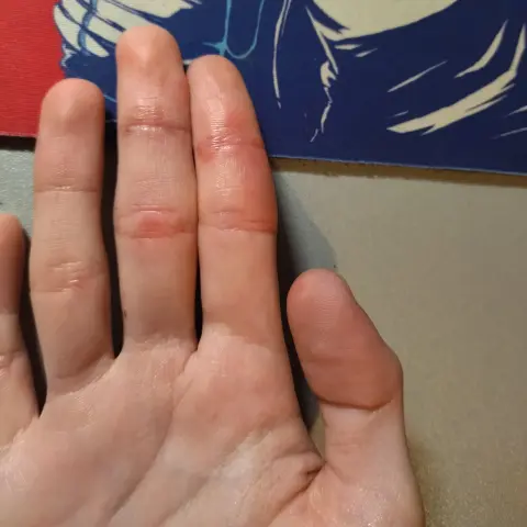 Foto dell'interno della mia mano destra, si vedono gli schifi del freddo principalmente su indice e medio, soprattutto sulle giunzioni