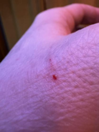 A gaping wound in the hand spewing blood