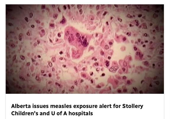 Alberta issues measles exposure alert for Stollery Children's and U of A hospitals